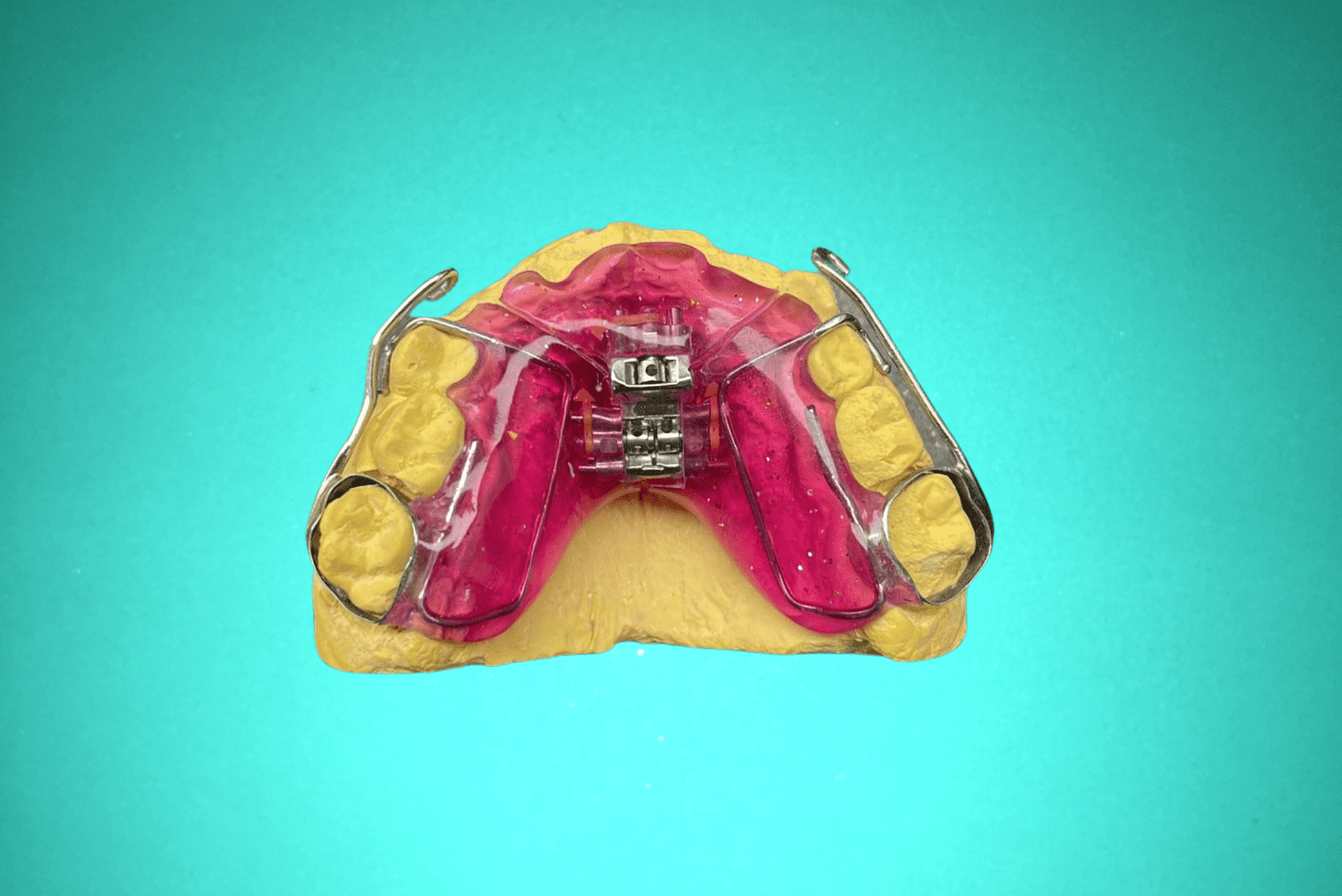 Plaque 3D fixe sur bague