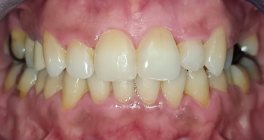 laboratoire-orthodontie-aligneur-invisible-rabat-prothesiste-dentaire-appareils-dentaires-gouttières-4d-ortho.png laboratoire-orthodontie-aligneur-invisible-rabat-prothesiste-dentaire-appareils-dentaires-gouttières-4d-ortho.png