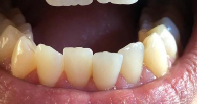 laboratoire-orthodontie-aligneur-invisible-rabat-prothesiste-dentaire-appareils-dentaires-gouttières-4d-ortho.png laboratoire-orthodontie-aligneur-invisible-rabat-prothesiste-dentaire-appareils-dentaires-gouttières-4d-ortho.png