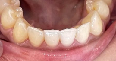 laboratoire-orthodontie-aligneur-invisible-rabat-prothesiste-dentaire-appareils-dentaires-gouttières-4d-ortho.png laboratoire-orthodontie-aligneur-invisible-rabat-prothesiste-dentaire-appareils-dentaires-gouttières-4d-ortho.png